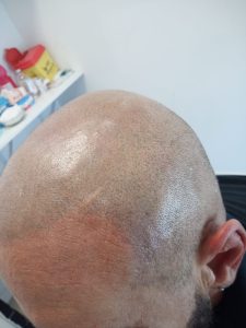 Federico: tricopigmentazione effetto rasato, con vezzo artistico tipo cicatrice