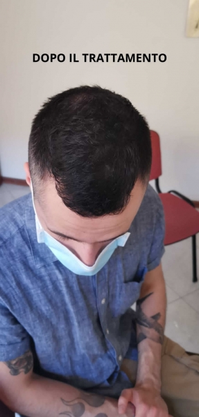 Marco_esempio_trattamento_alopecia_maschile_DOPO